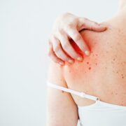 How to Track Your Skin Symptoms for Better Doctor Visits