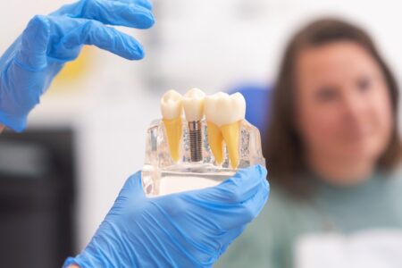 Myths and Facts About Dental Implants