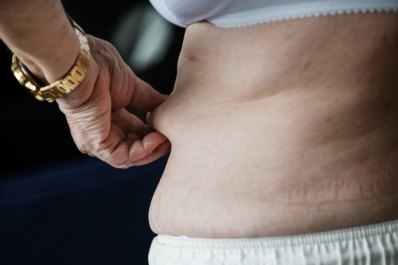Patient Safety Tips for Abdominoplasty Procedures in Toronto